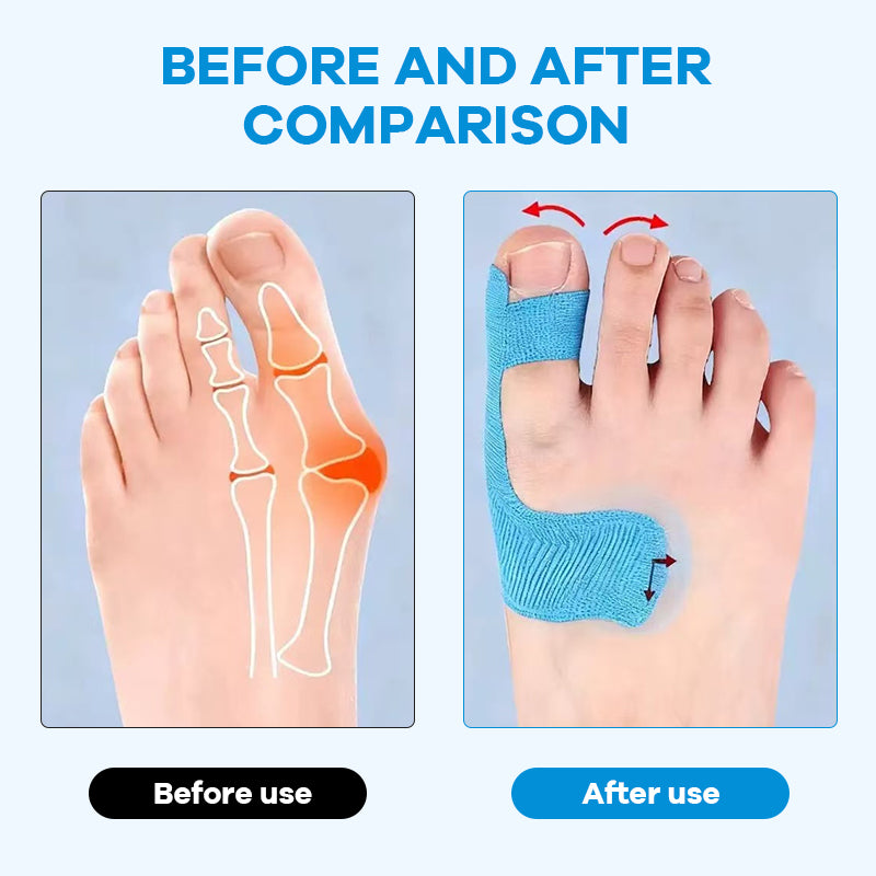 Valmiiksi leikattu kinesioteippi hallux valgus -luunpohjan luunmurtumiin